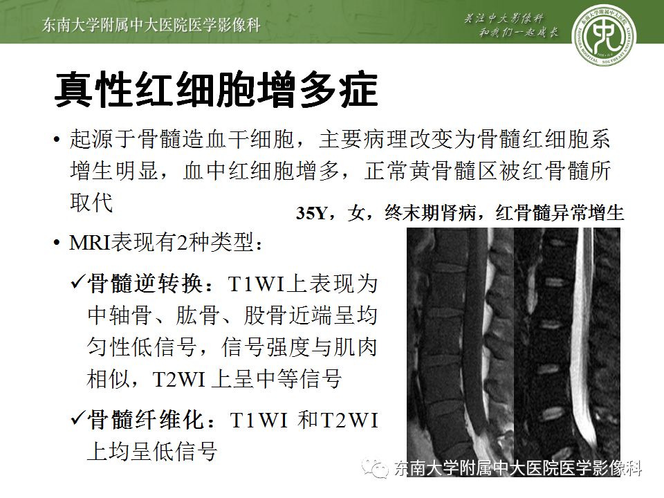 【病例】白血病骨髓浸润1例MR影像表现 【病例】白血病骨髓浸润1例MR影像表现