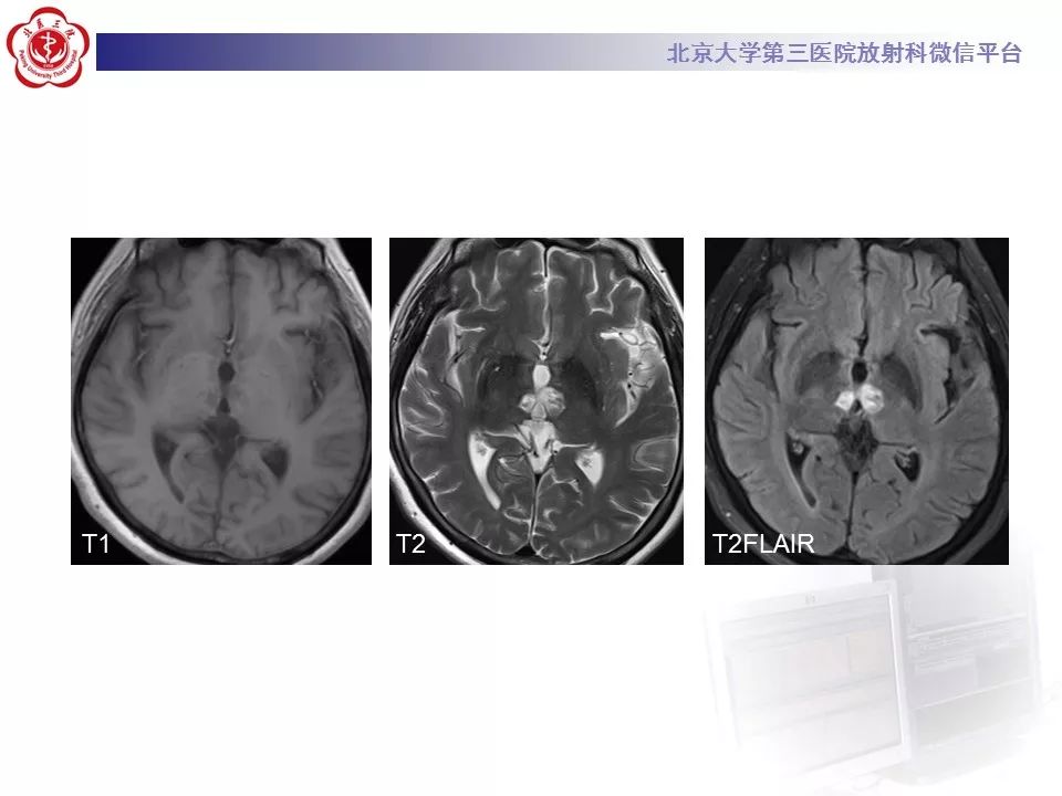 【病例】基底动脉尖综合征2例影像诊断