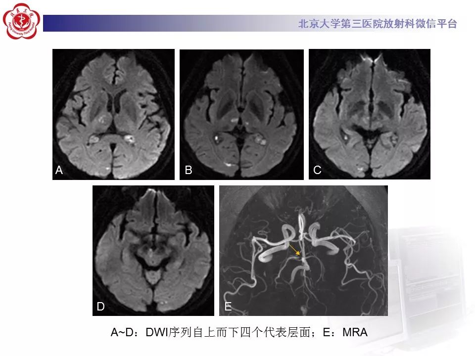 【病例】基底动脉尖综合征2例影像诊断