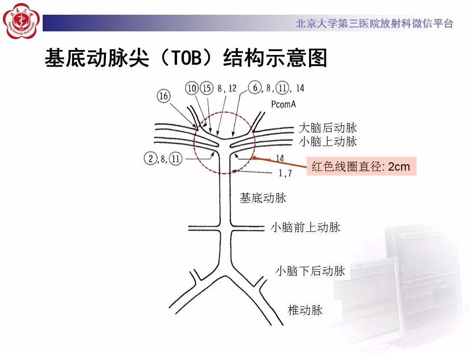 【病例】基底动脉尖综合征2例影像诊断