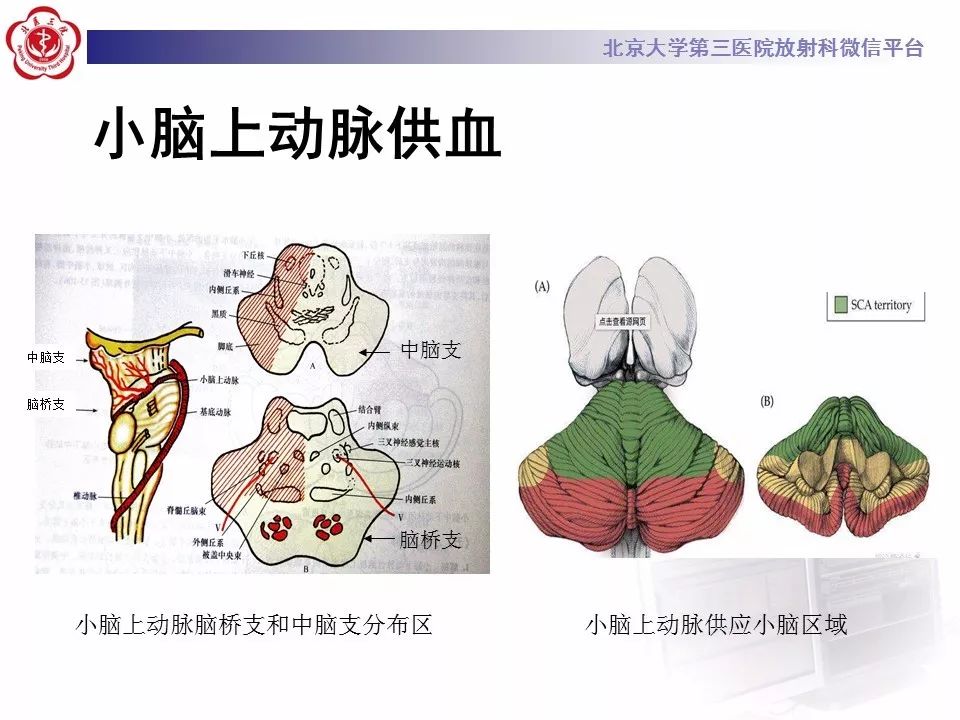 【病例】基底动脉尖综合征2例影像诊断