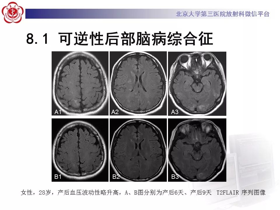 【病例】基底动脉尖综合征2例影像诊断