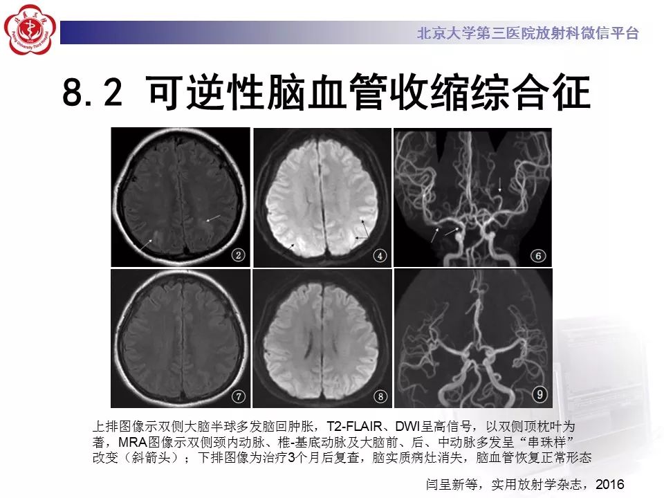 【病例】基底动脉尖综合征2例影像诊断