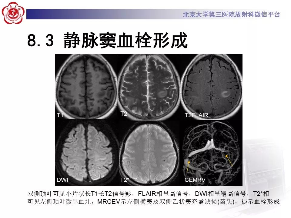 【病例】基底动脉尖综合征2例影像诊断
