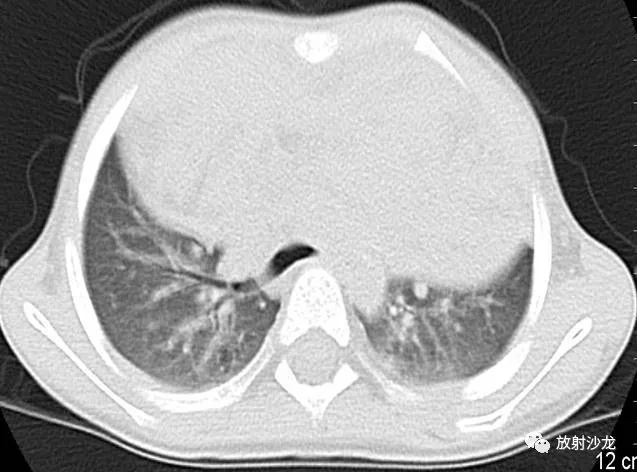 【病例】小儿真性胸腺增生1例CT影像表现