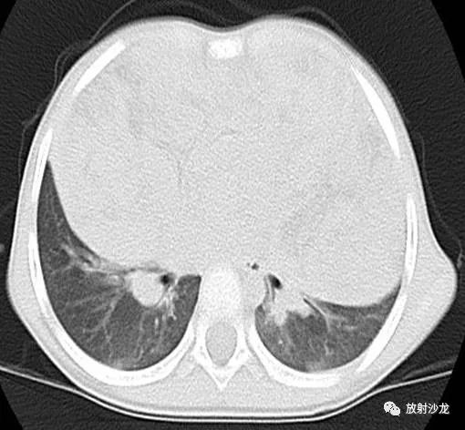 【病例】小儿真性胸腺增生1例CT影像表现