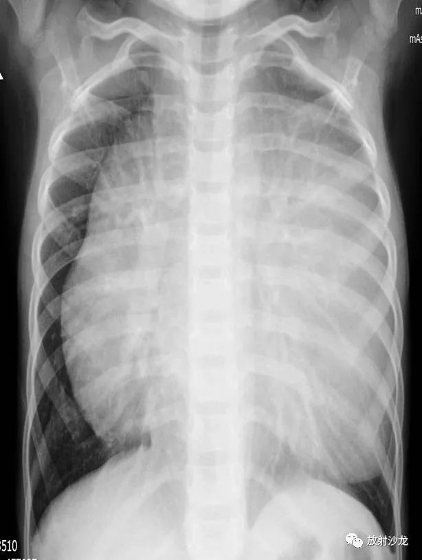 【病例】小儿真性胸腺增生1例CT影像表现