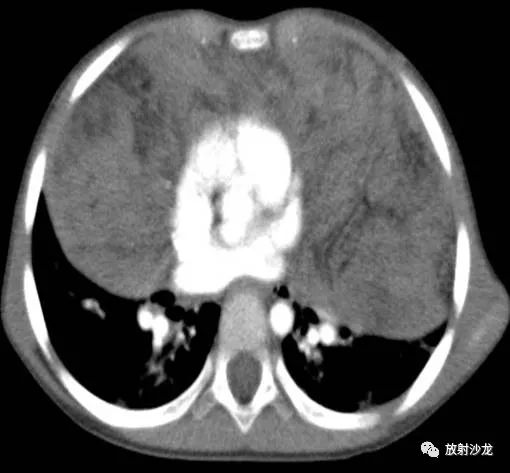 【病例】小儿真性胸腺增生1例CT影像表现