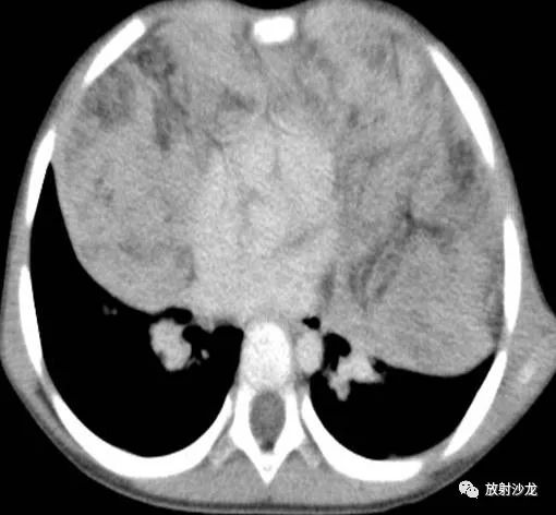 【病例】小儿真性胸腺增生1例CT影像表现