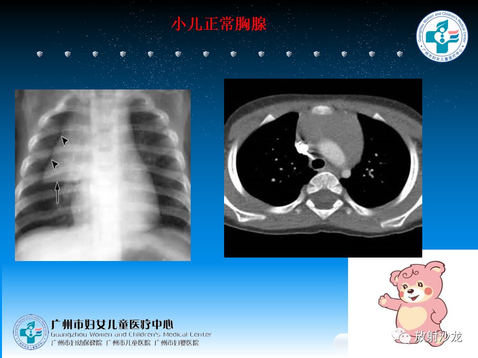 【病例】小儿真性胸腺增生1例CT影像表现