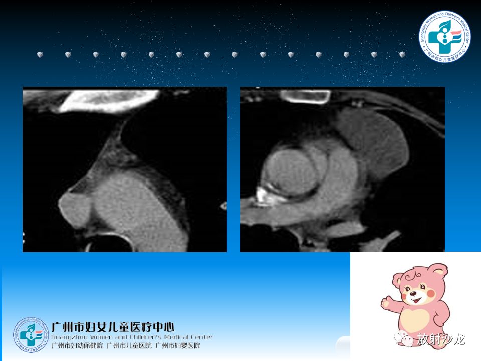 【病例】小儿真性胸腺增生1例CT影像表现