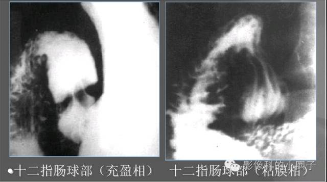 正常小肠影像解剖与分组 正常小肠影像解剖与分组