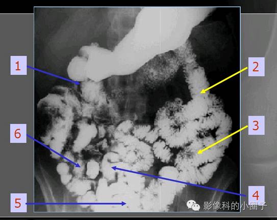 正常小肠影像解剖与分组 正常小肠影像解剖与分组