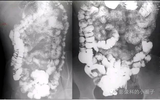 正常小肠影像解剖与分组 正常小肠影像解剖与分组