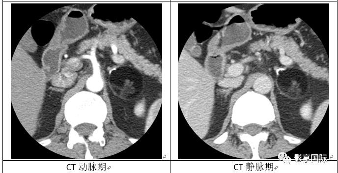 【病例】肾上腺囊性成熟性畸胎瘤1例CT及MR影像表现 【病例】肾上腺囊性成熟性畸胎瘤1例CT及MR影像表现