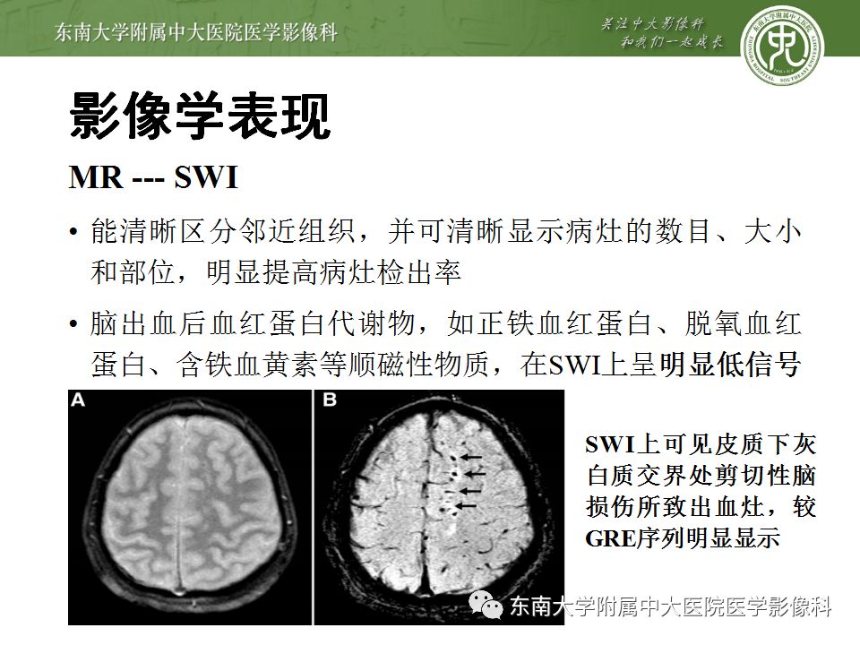 【病例】弥漫性轴索损伤1例CT影像表现