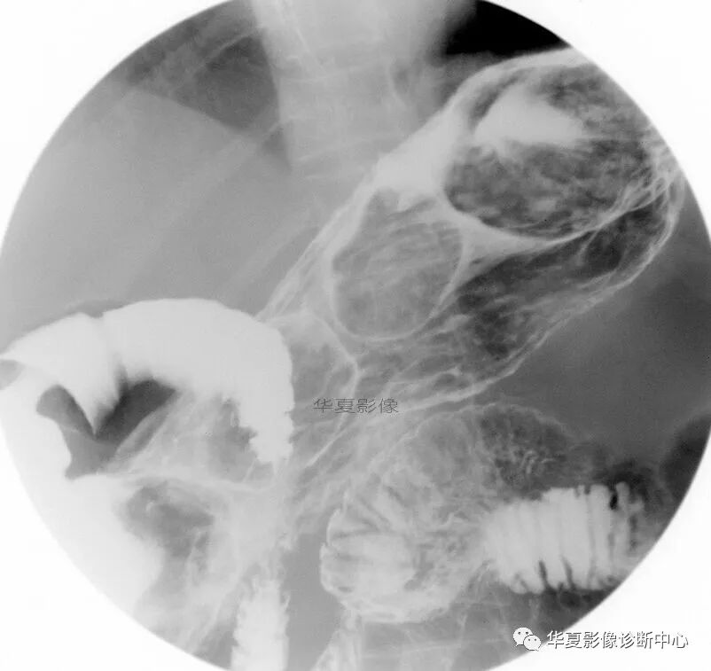 【病例】胃石1例X线影像表现 【病例】胃石1例X线影像表现