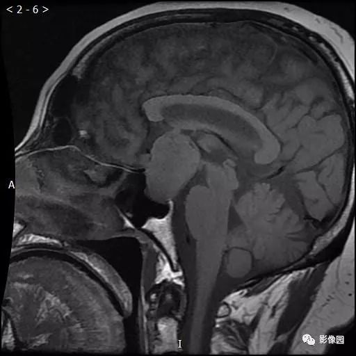【病例】垂体瘤1例MR影像表现 【病例】垂体瘤1例MR影像表现