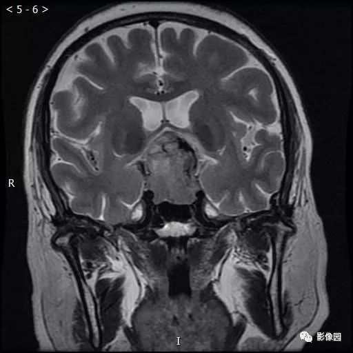 【病例】垂体瘤1例MR影像表现 【病例】垂体瘤1例MR影像表现