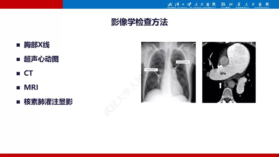 【PPT】肺动脉高压临床分类及CT表现