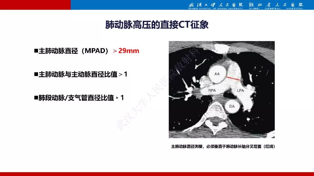 【PPT】肺动脉高压临床分类及CT表现