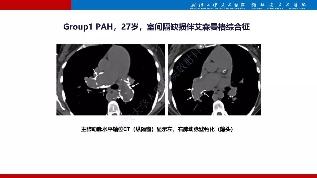 【PPT】肺动脉高压临床分类及CT表现