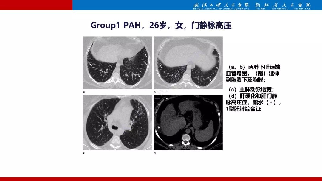 【PPT】肺动脉高压临床分类及CT表现
