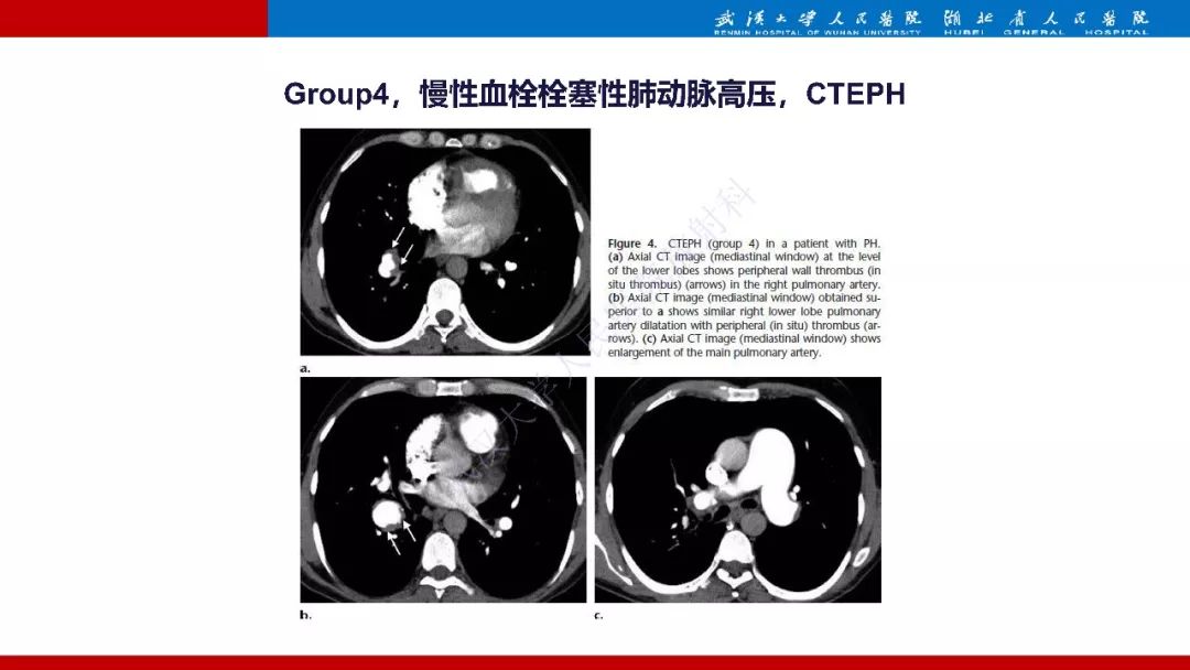 【PPT】肺动脉高压临床分类及CT表现