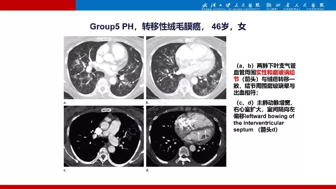 【PPT】肺动脉高压临床分类及CT表现