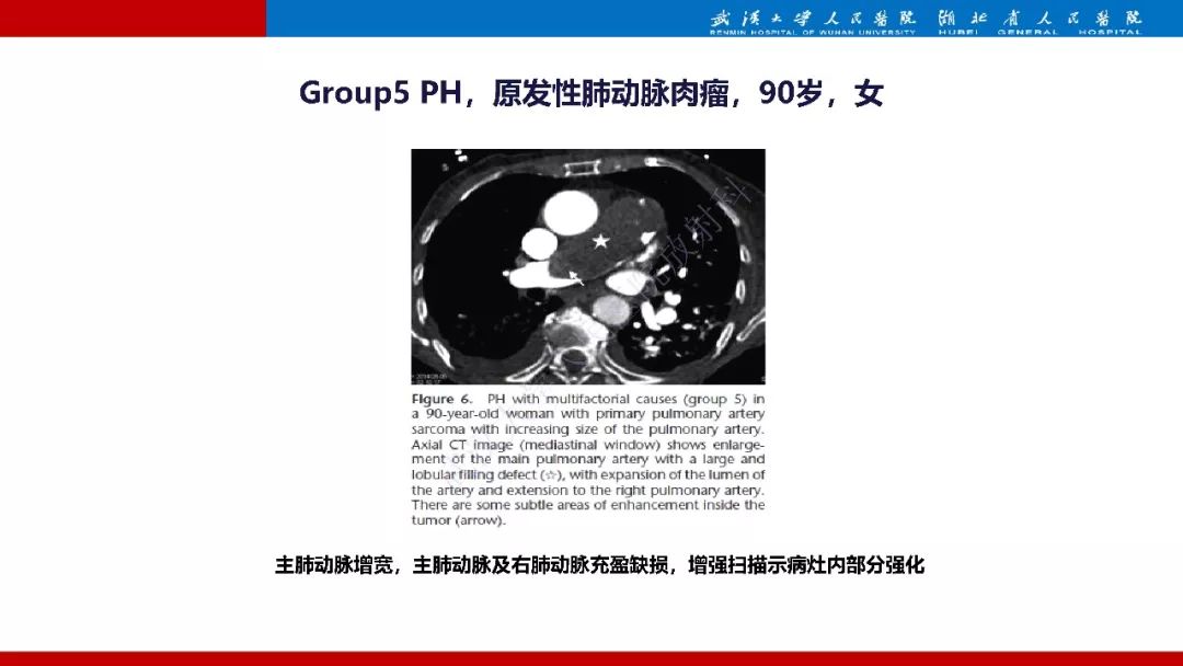 【PPT】肺动脉高压临床分类及CT表现