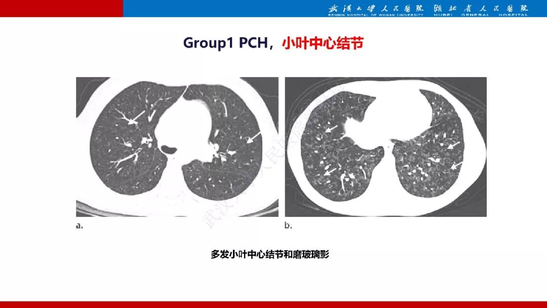【PPT】肺动脉高压临床分类及CT表现