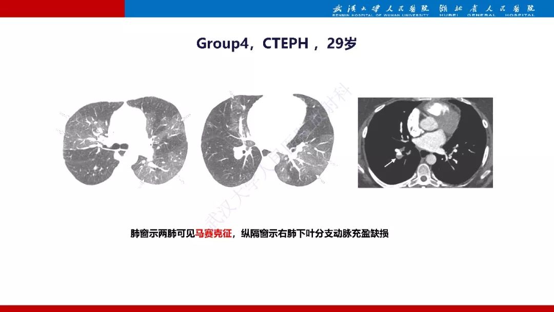 【PPT】肺动脉高压临床分类及CT表现