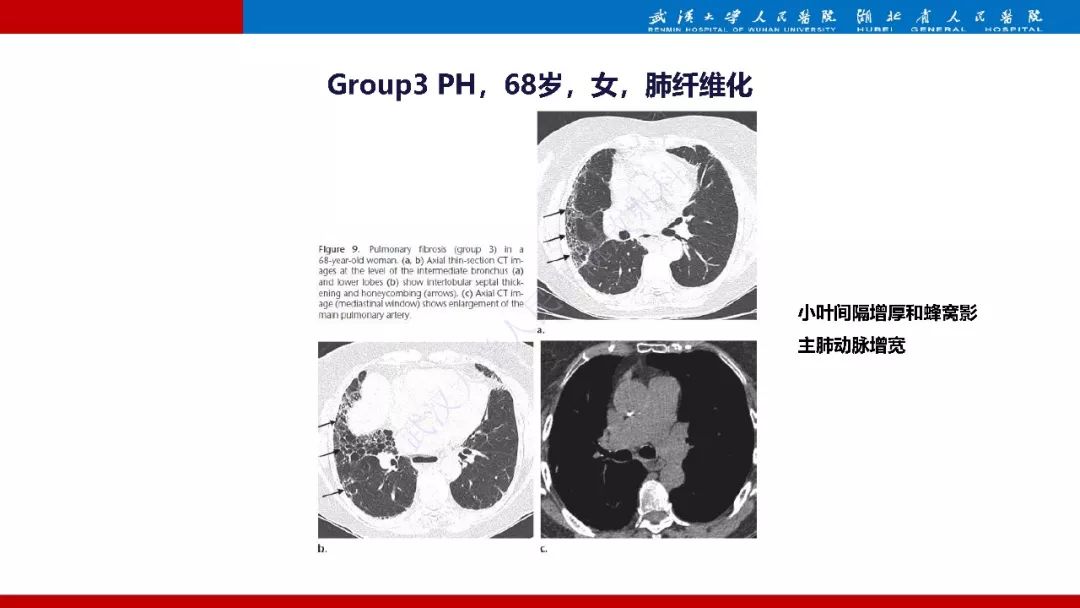 【PPT】肺动脉高压临床分类及CT表现