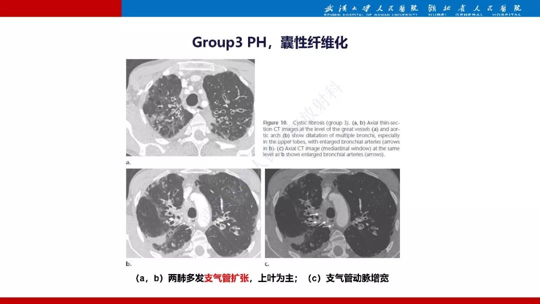 【PPT】肺动脉高压临床分类及CT表现