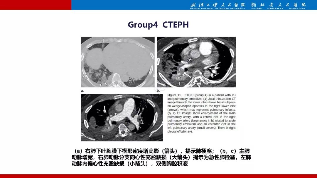 【PPT】肺动脉高压临床分类及CT表现