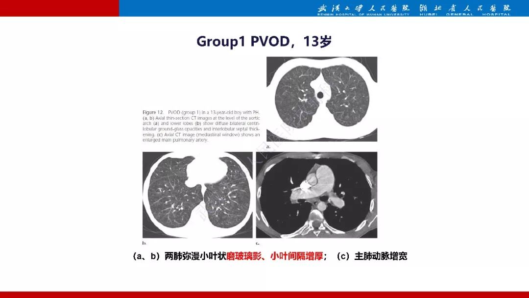 【PPT】肺动脉高压临床分类及CT表现