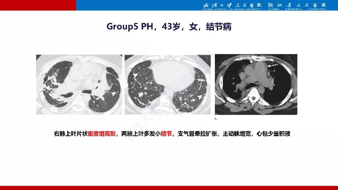 【PPT】肺动脉高压临床分类及CT表现