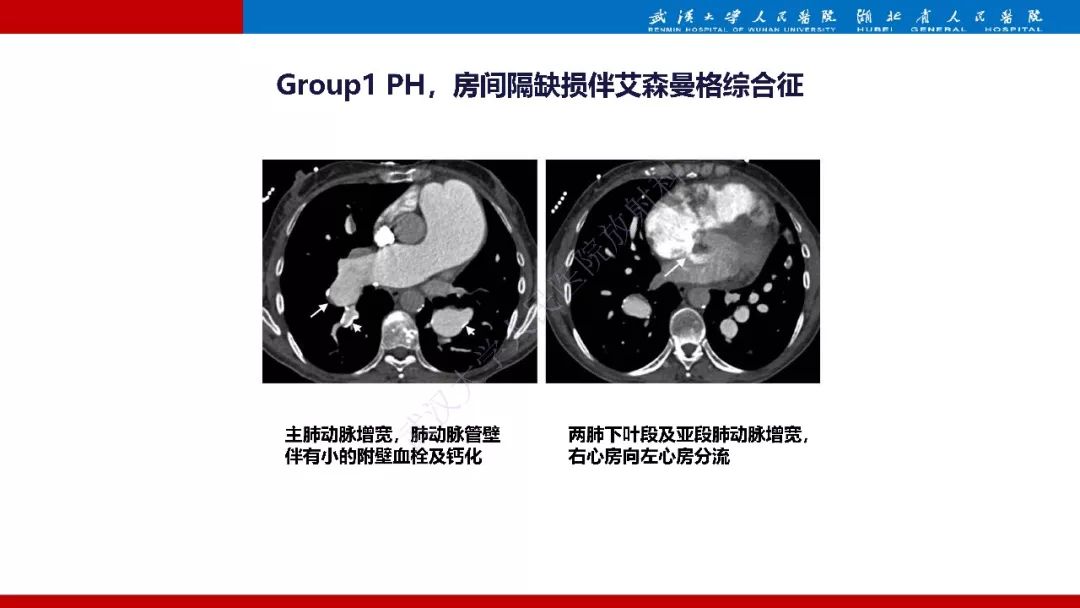 【PPT】肺动脉高压临床分类及CT表现