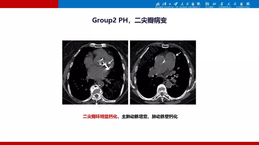 【PPT】肺动脉高压临床分类及CT表现