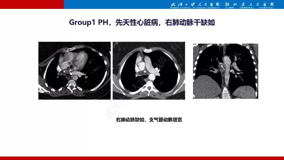 【PPT】肺动脉高压临床分类及CT表现