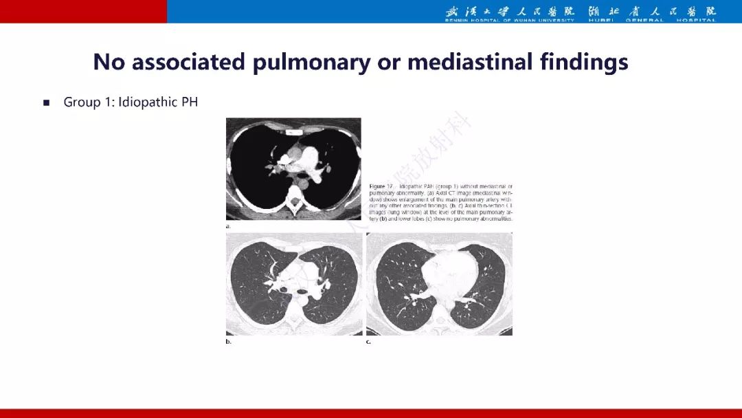 【PPT】肺动脉高压临床分类及CT表现