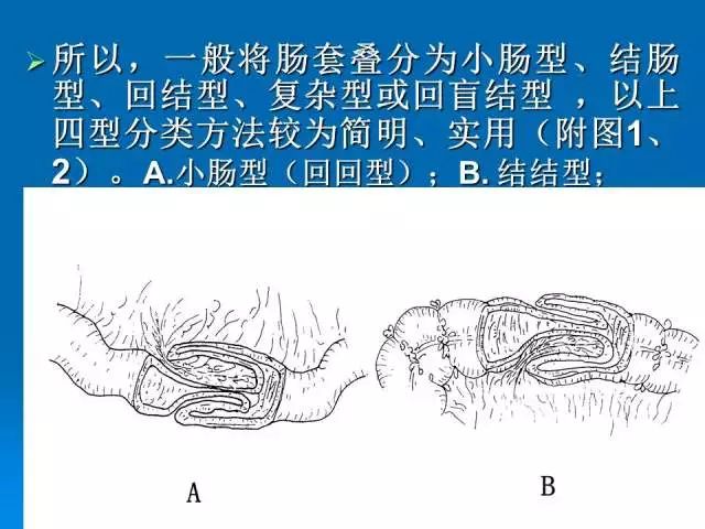 【PPT】小儿急性肠套叠空气灌肠难整复之征象、原因及应对措施