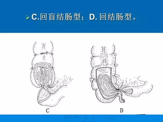 【PPT】小儿急性肠套叠空气灌肠难整复之征象、原因及应对措施