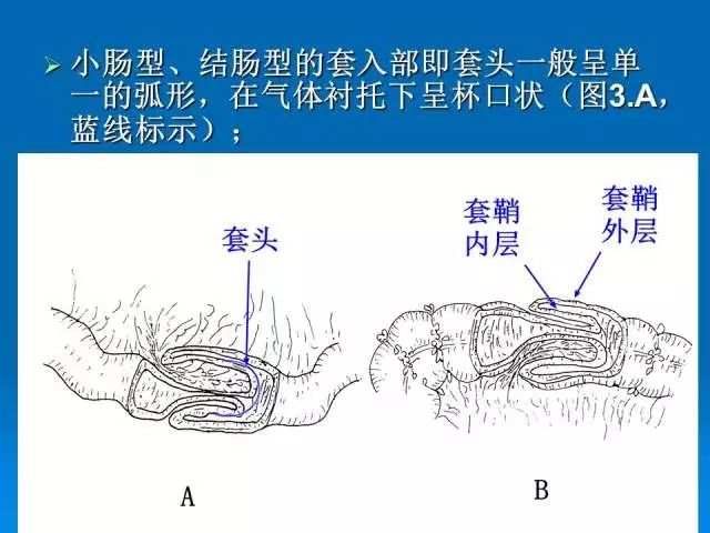【PPT】小儿急性肠套叠空气灌肠难整复之征象、原因及应对措施