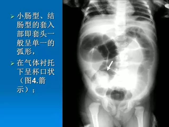 【PPT】小儿急性肠套叠空气灌肠难整复之征象、原因及应对措施