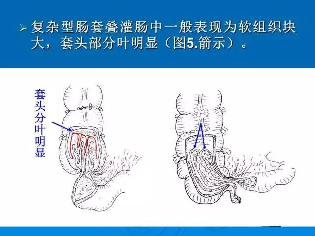 【PPT】小儿急性肠套叠空气灌肠难整复之征象、原因及应对措施