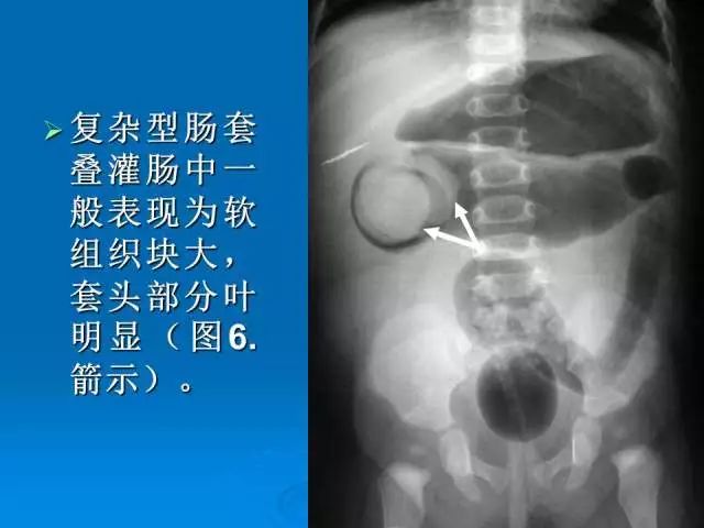 【PPT】小儿急性肠套叠空气灌肠难整复之征象、原因及应对措施