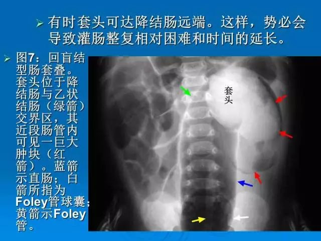 【PPT】小儿急性肠套叠空气灌肠难整复之征象、原因及应对措施
