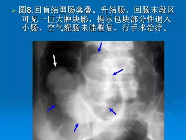 【PPT】小儿急性肠套叠空气灌肠难整复之征象、原因及应对措施