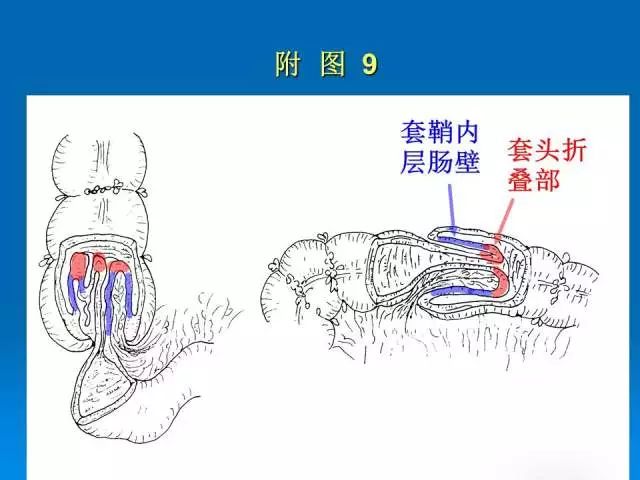 【PPT】小儿急性肠套叠空气灌肠难整复之征象、原因及应对措施